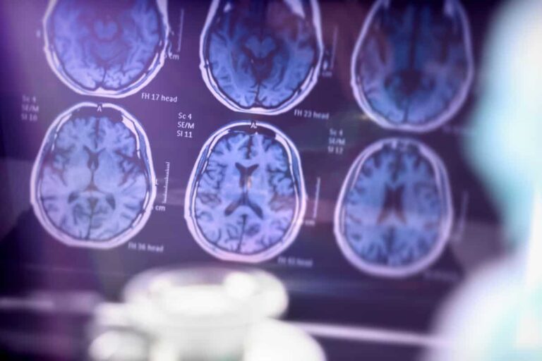 penyakit alzheimer